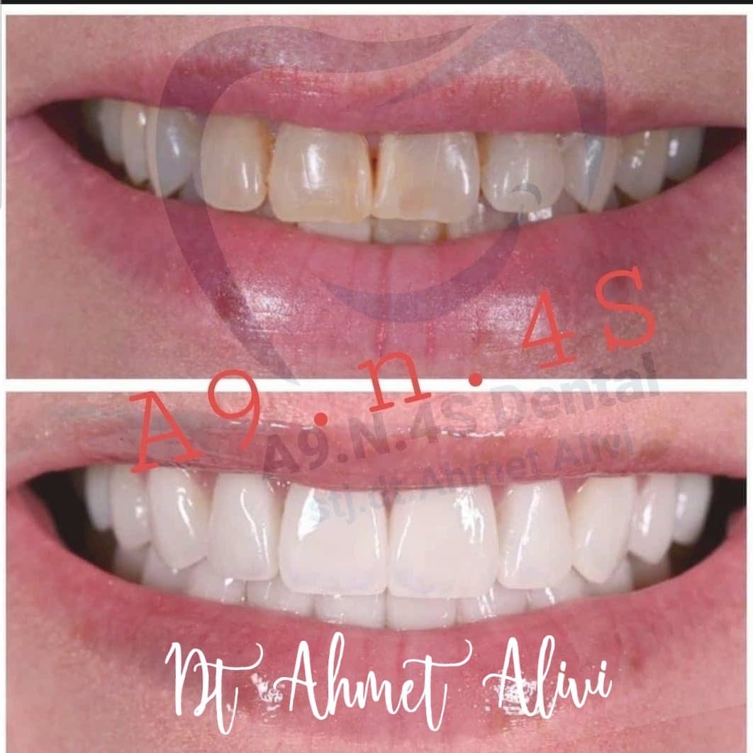 Patient smile transformation before and after #10 — Dr. Alivi Dental Clinic Istanbul