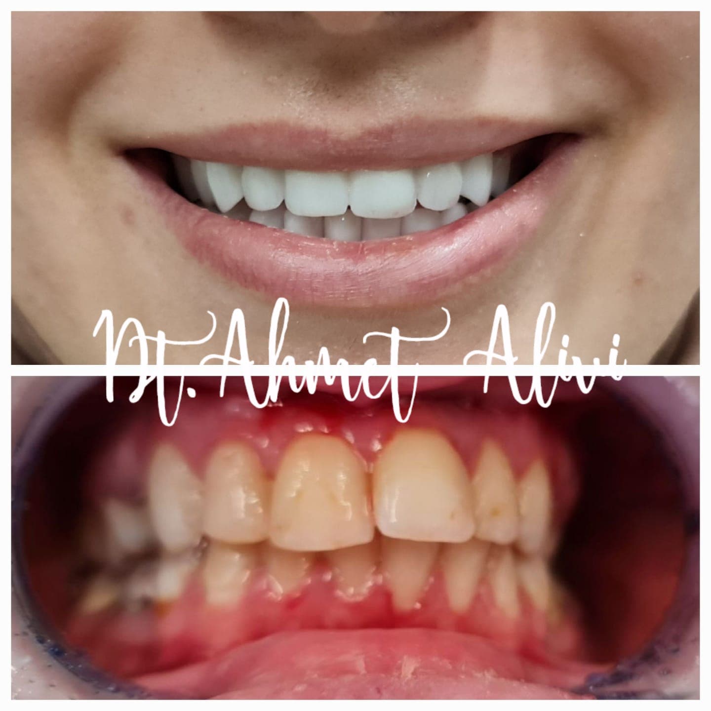 Patient smile transformation before and after #11 — Dr. Alivi Dental Clinic Istanbul