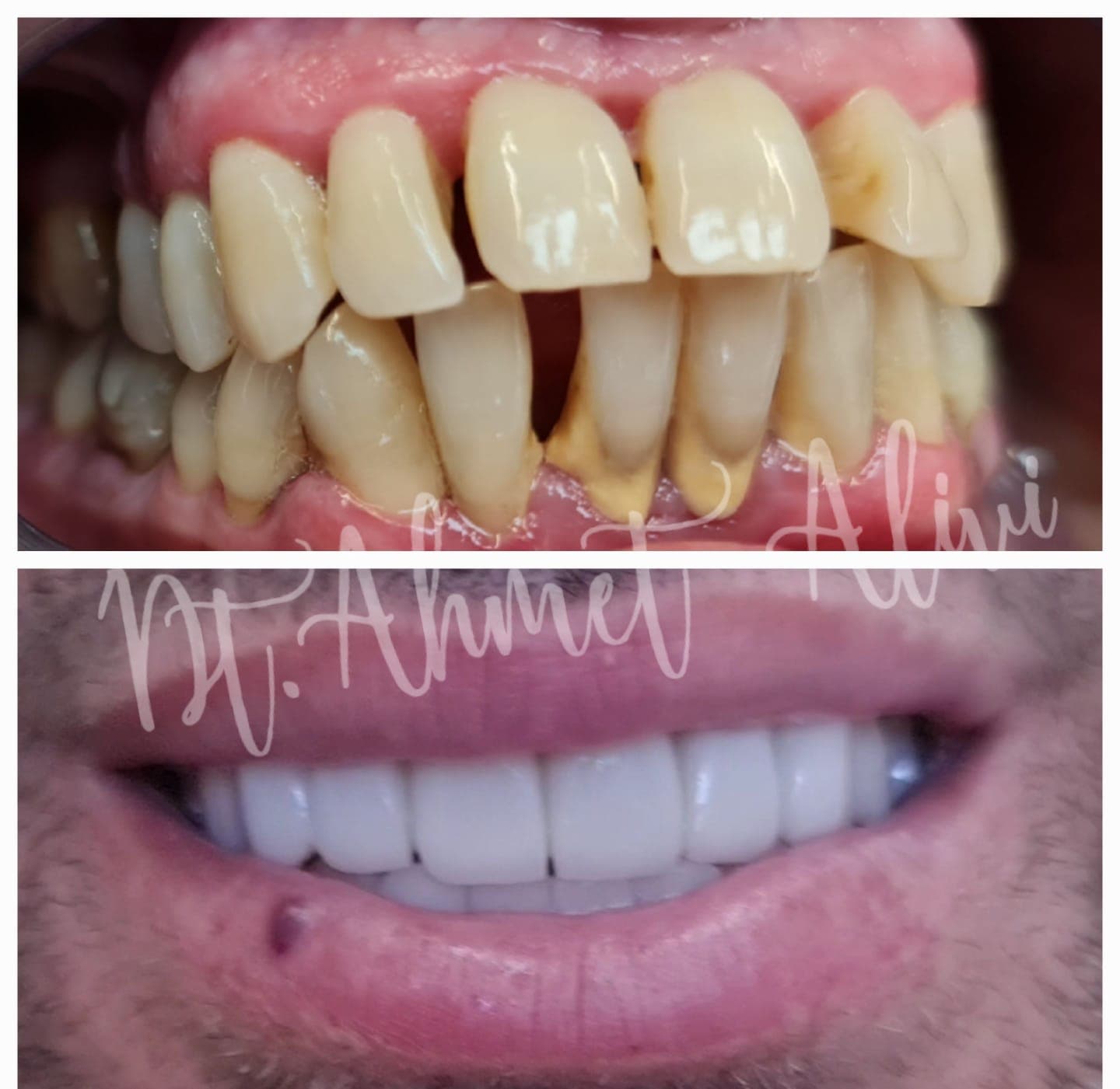 Patient smile transformation before and after #12 — Dr. Alivi Dental Clinic Istanbul