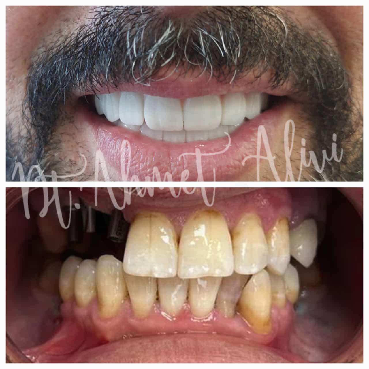 Patient smile transformation before and after #13 — Dr. Alivi Dental Clinic Istanbul