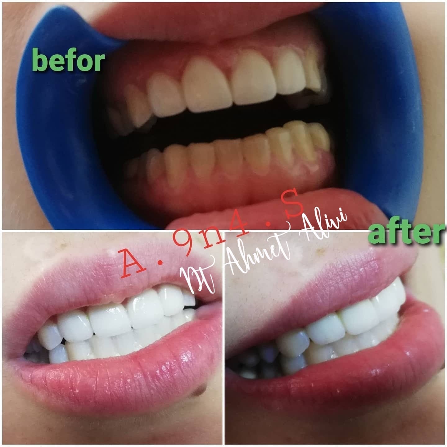 Patient smile transformation before and after #14 — Dr. Alivi Dental Clinic Istanbul