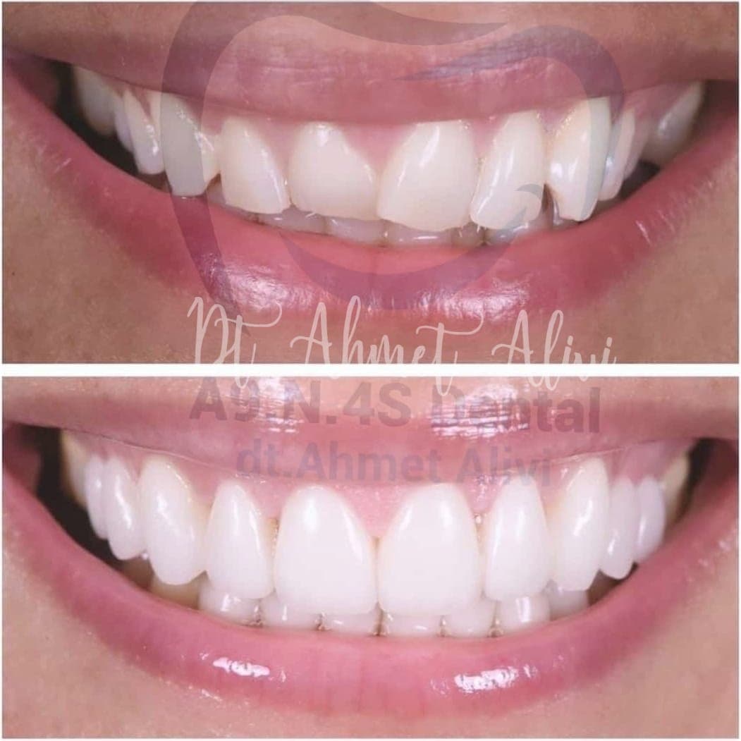 Patient smile transformation before and after #15 — Dr. Alivi Dental Clinic Istanbul