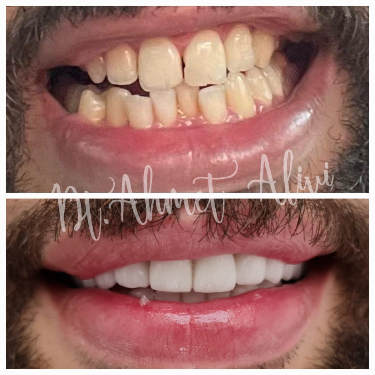Patient smile transformation before and after #16 — Dr. Alivi Dental Clinic Istanbul