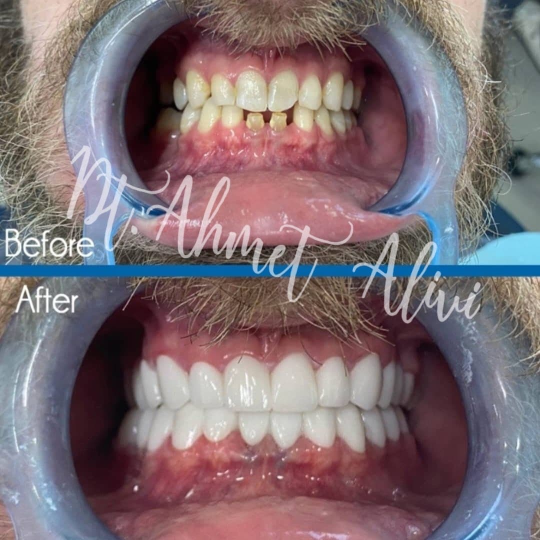 Patient smile transformation before and after #17 — Dr. Alivi Dental Clinic Istanbul