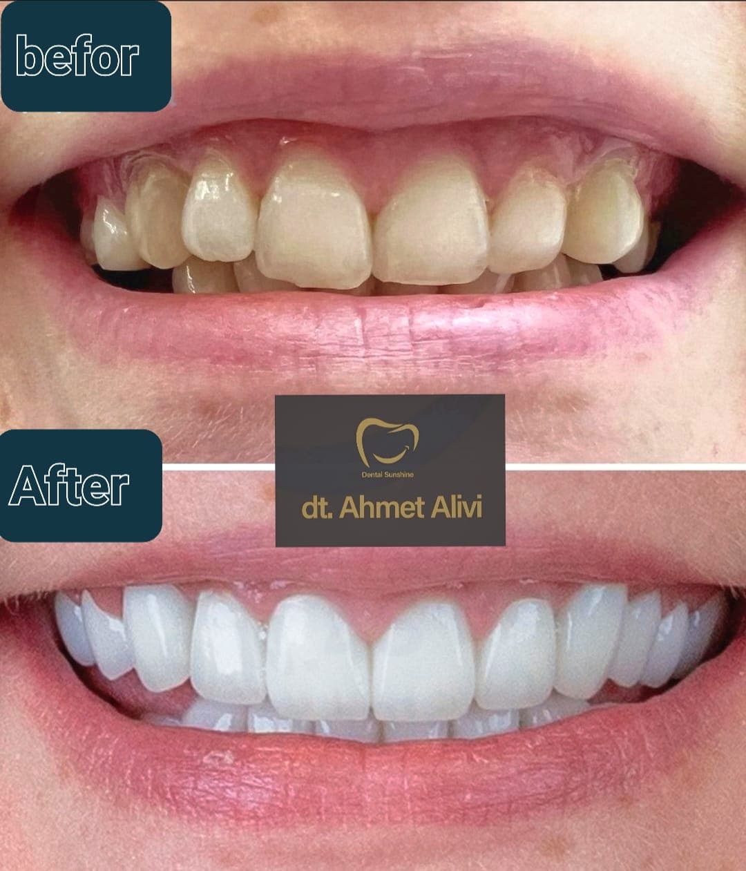 Patient smile transformation before and after #18 — Dr. Alivi Dental Clinic Istanbul