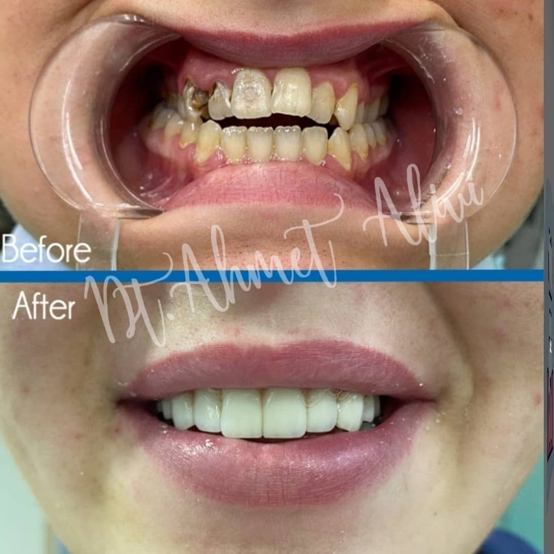 Patient smile transformation before and after #19 — Dr. Alivi Dental Clinic Istanbul