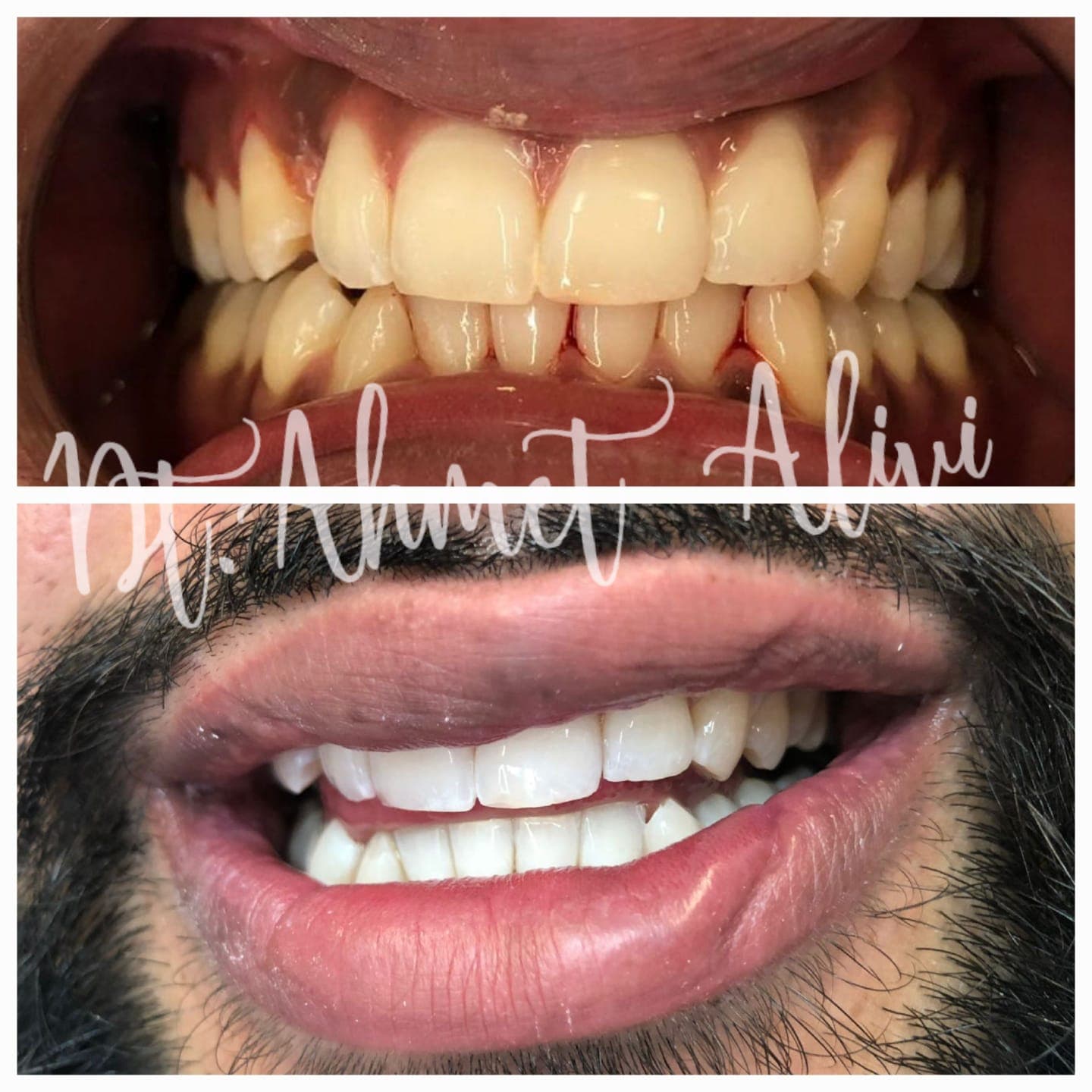 Patient smile transformation before and after #20 — Dr. Alivi Dental Clinic Istanbul