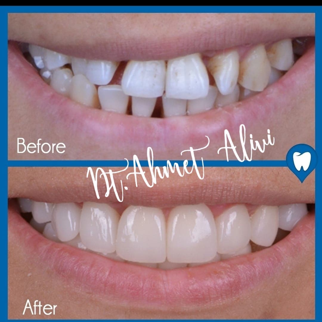Patient smile transformation before and after #21 — Dr. Alivi Dental Clinic Istanbul