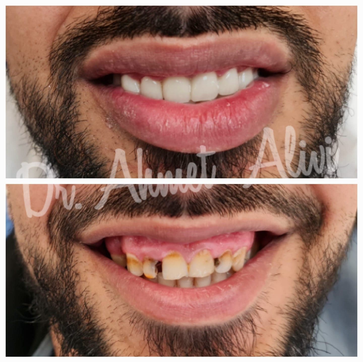 Patient smile transformation before and after #22 — Dr. Alivi Dental Clinic Istanbul