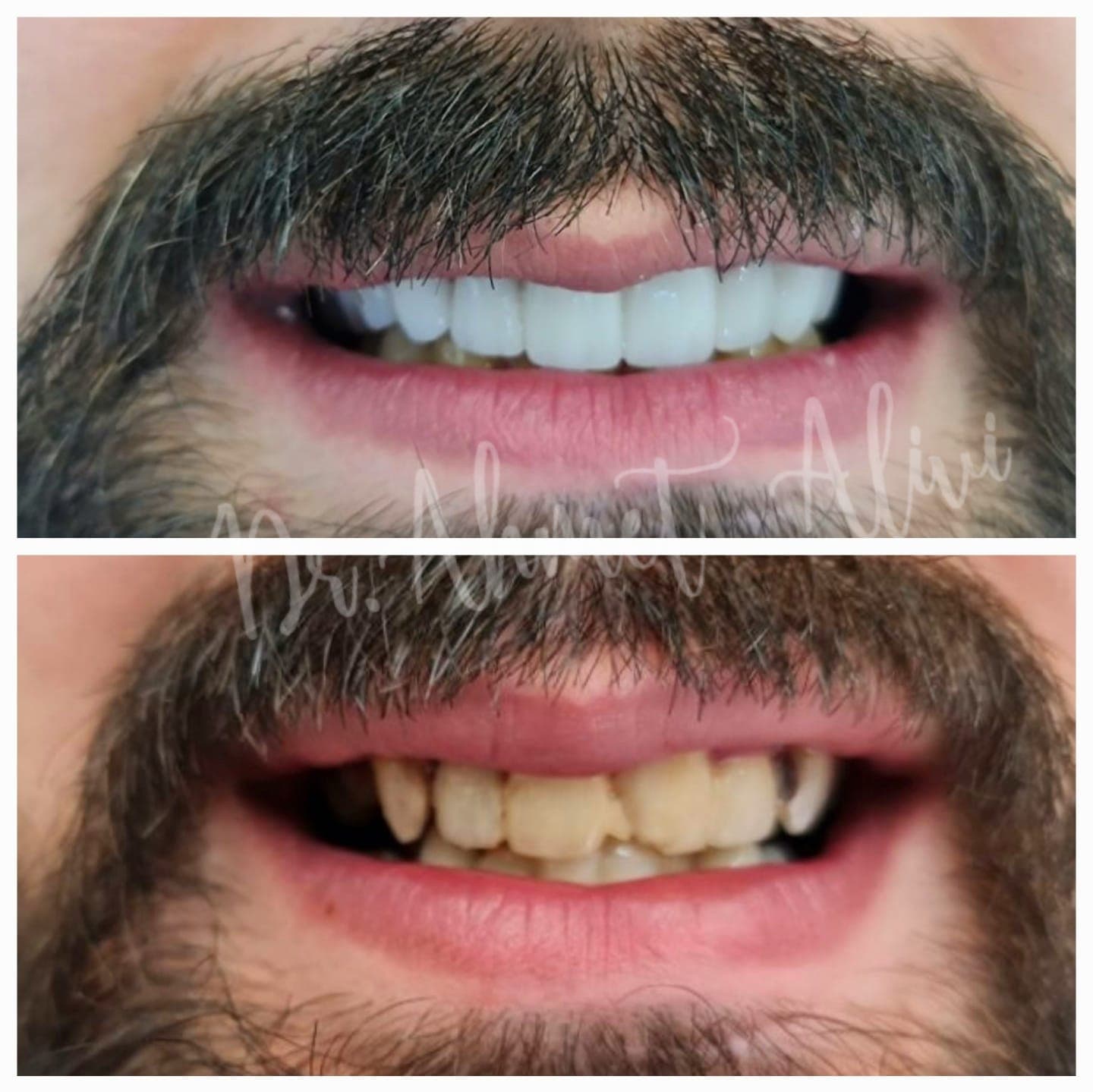 Patient smile transformation before and after #23 — Dr. Alivi Dental Clinic Istanbul