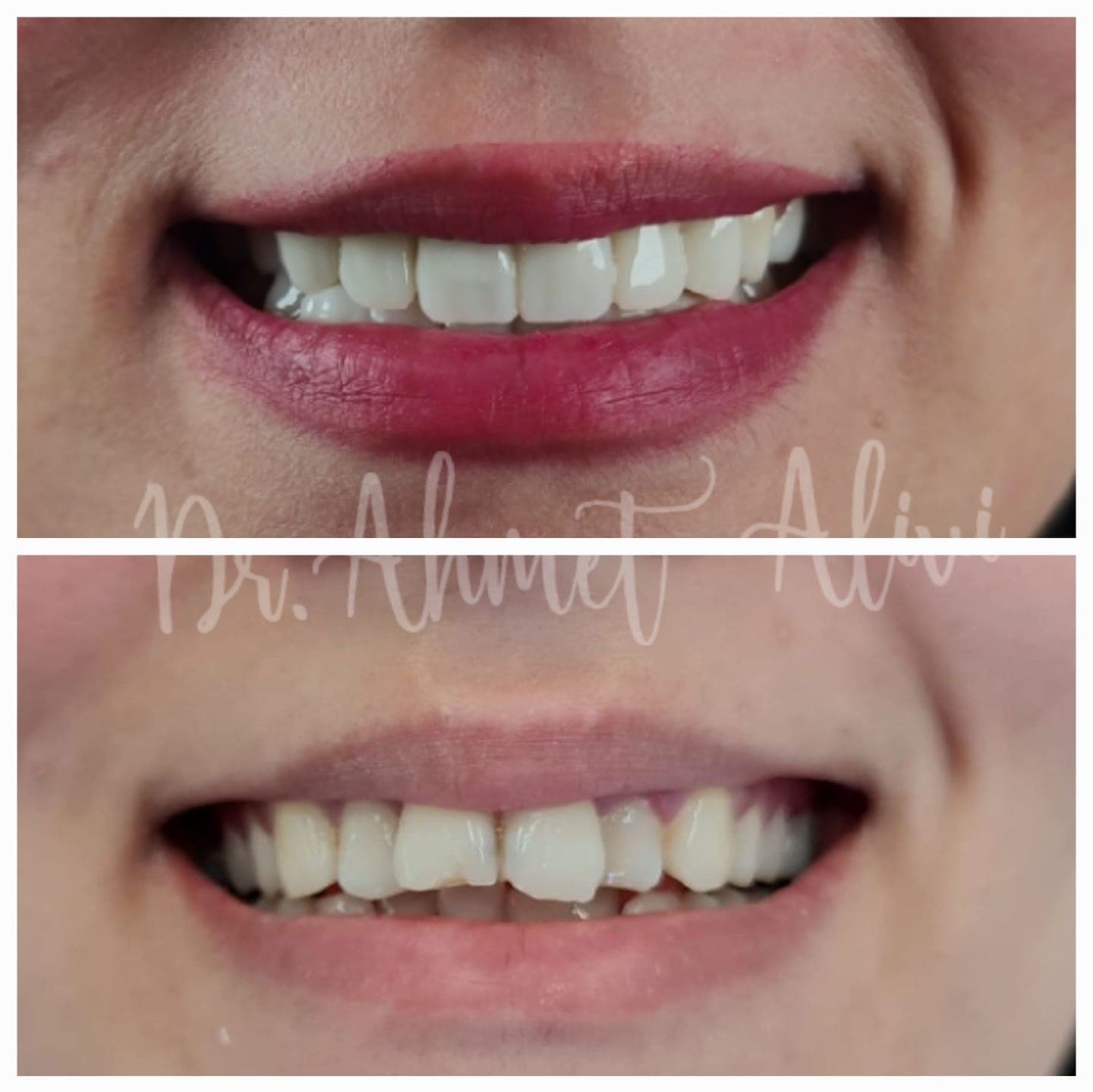 Patient smile transformation before and after #24 — Dr. Alivi Dental Clinic Istanbul