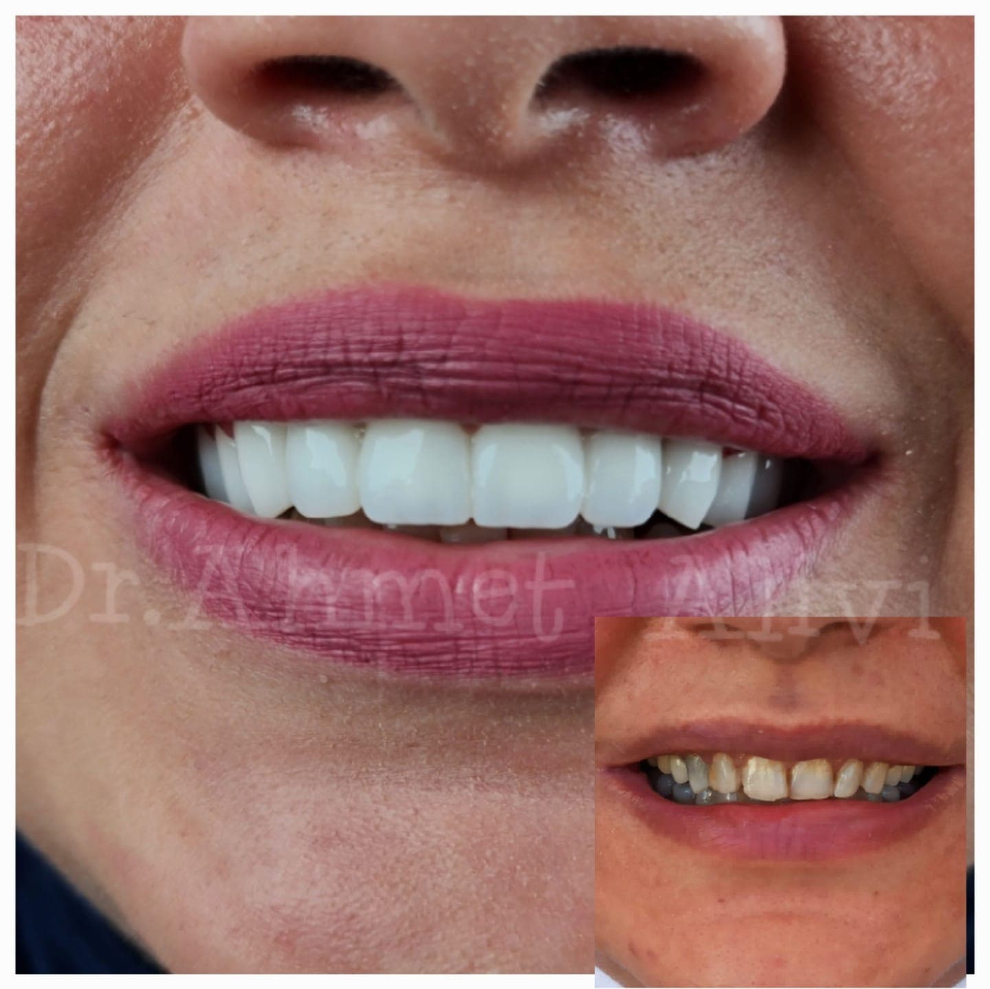 Patient smile transformation before and after #25 — Dr. Alivi Dental Clinic Istanbul