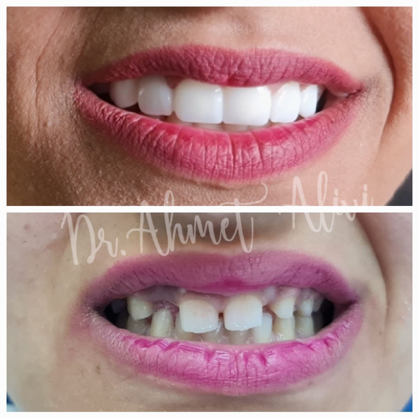 Patient smile transformation before and after #26 — Dr. Alivi Dental Clinic Istanbul