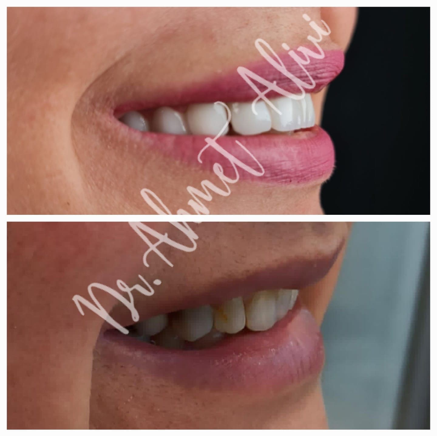 Patient smile transformation before and after #27 — Dr. Alivi Dental Clinic Istanbul