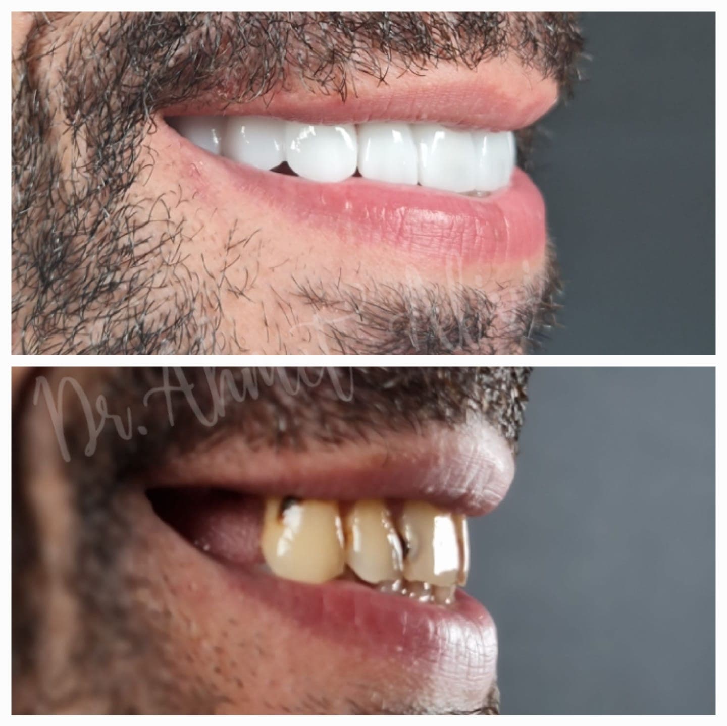 Patient smile transformation before and after #28 — Dr. Alivi Dental Clinic Istanbul