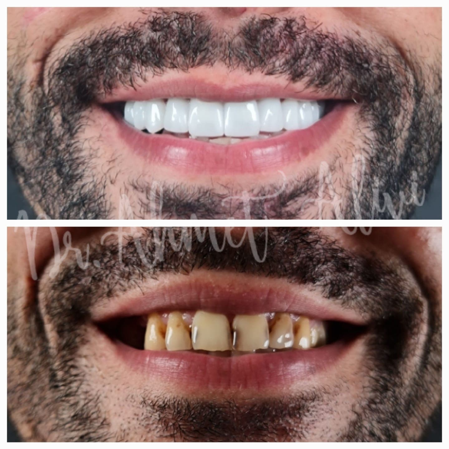 Patient smile transformation before and after #29 — Dr. Alivi Dental Clinic Istanbul