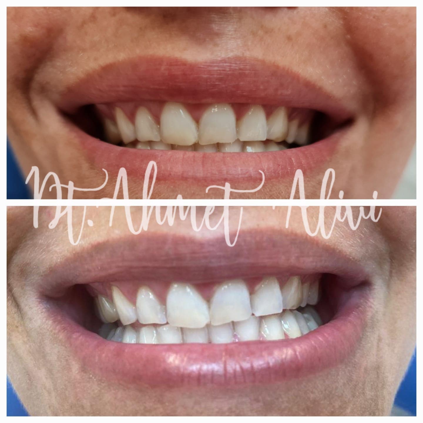 Patient smile transformation before and after #3 — Dr. Alivi Dental Clinic Istanbul