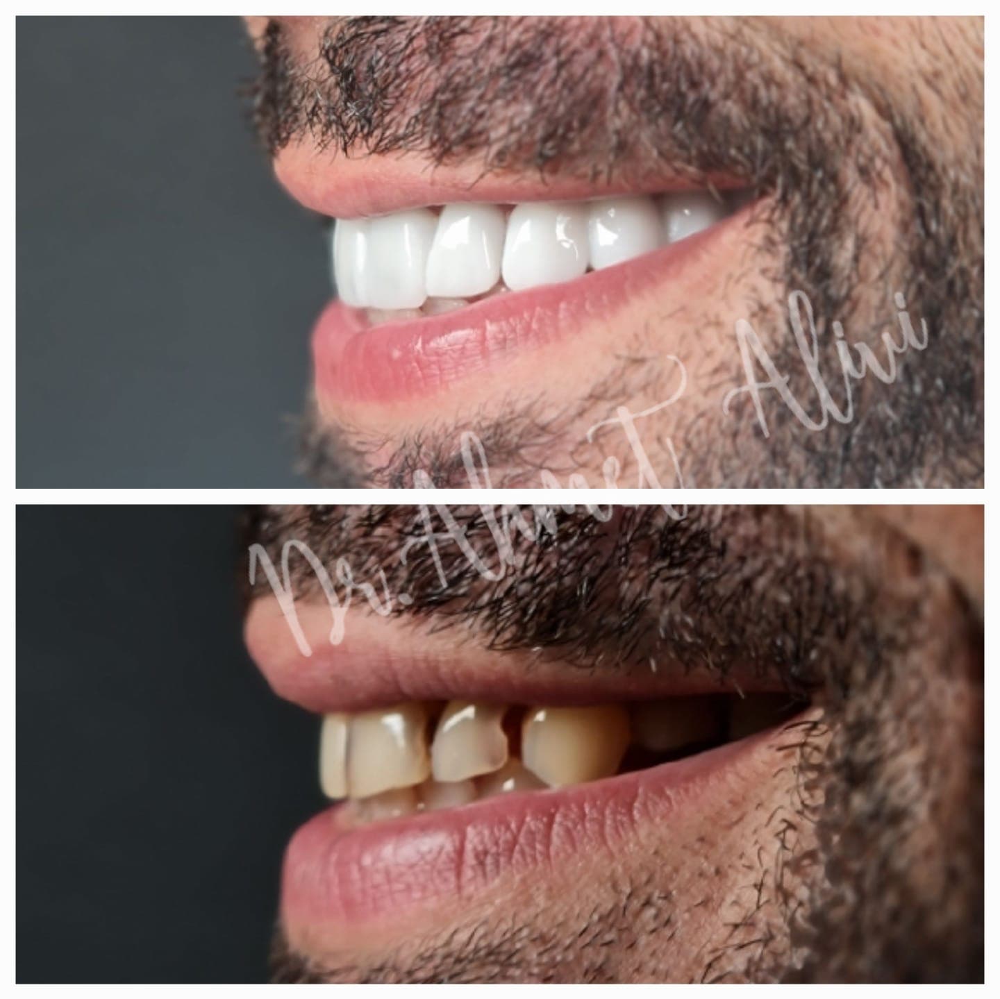 Patient smile transformation before and after #30 — Dr. Alivi Dental Clinic Istanbul
