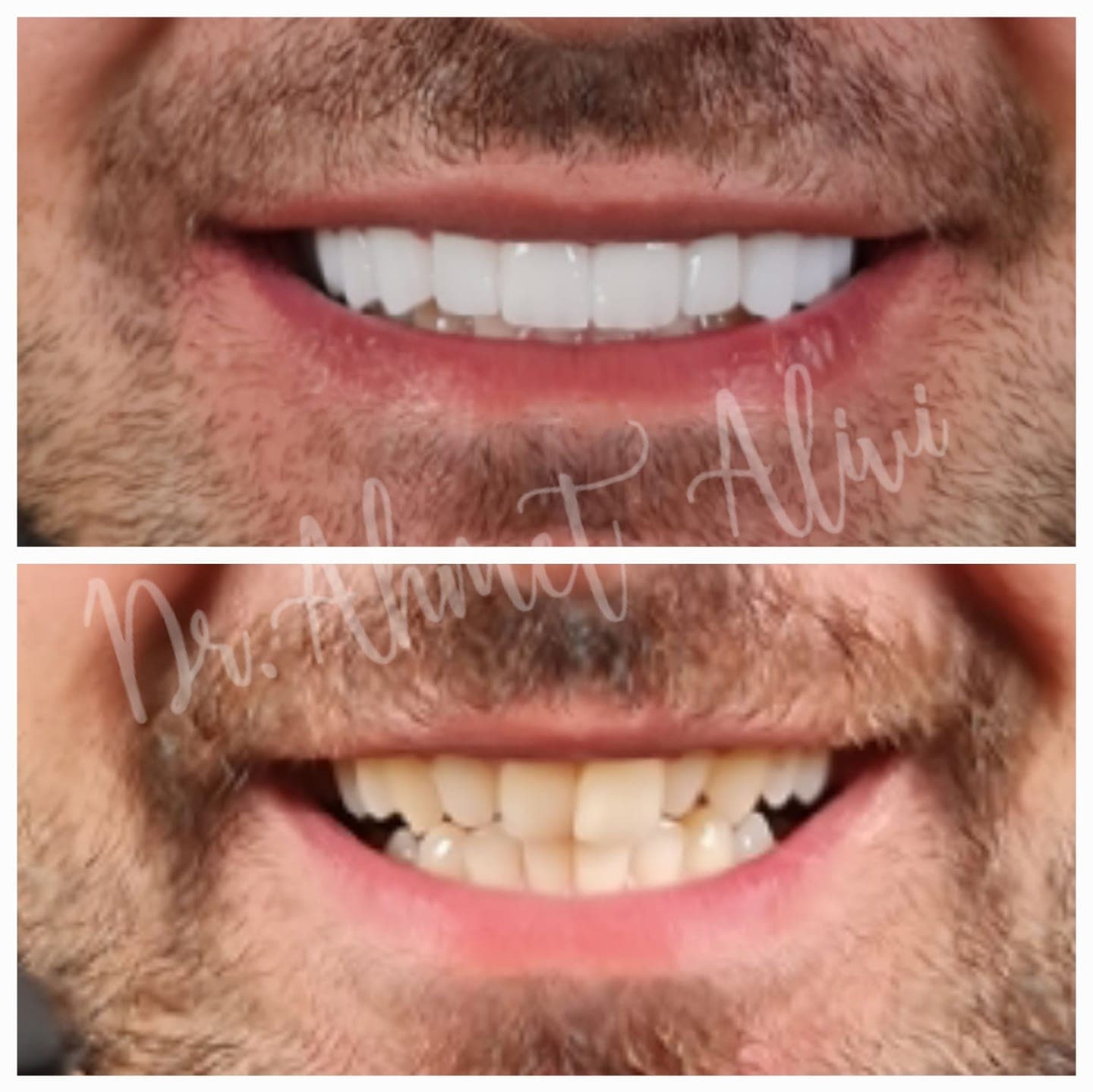 Patient smile transformation before and after #31 — Dr. Alivi Dental Clinic Istanbul