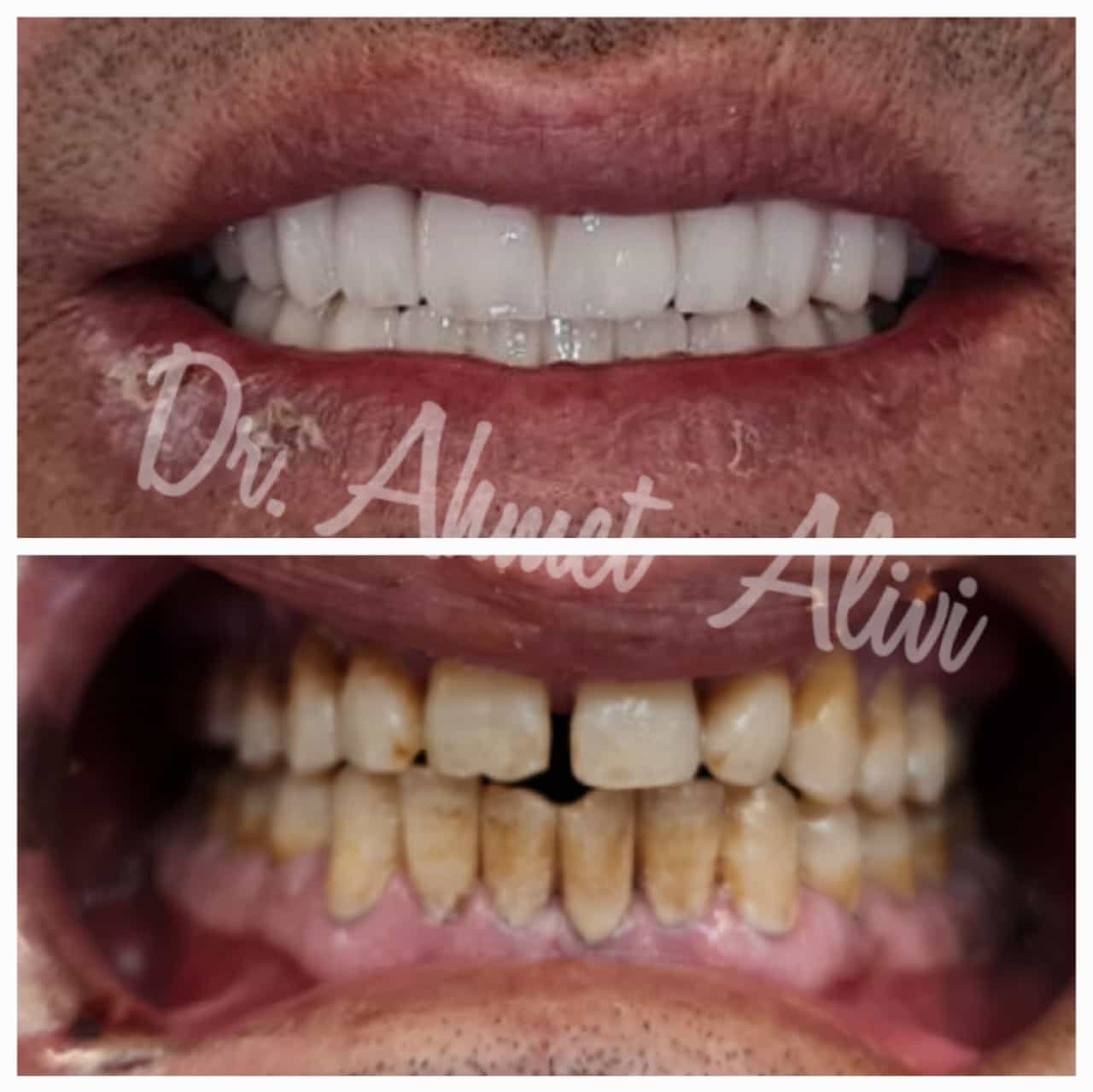 Patient smile transformation before and after #32 — Dr. Alivi Dental Clinic Istanbul