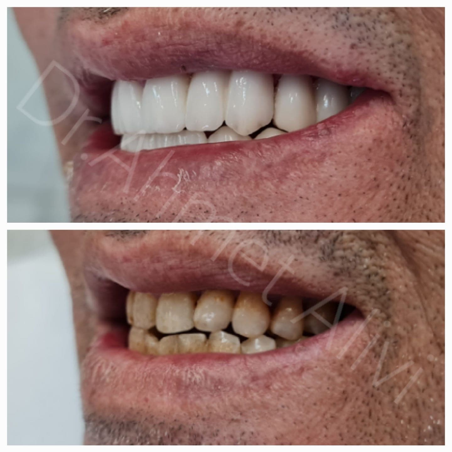 Patient smile transformation before and after #33 — Dr. Alivi Dental Clinic Istanbul