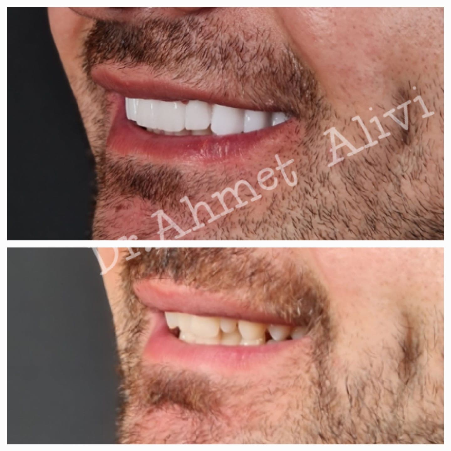 Patient smile transformation before and after #34 — Dr. Alivi Dental Clinic Istanbul