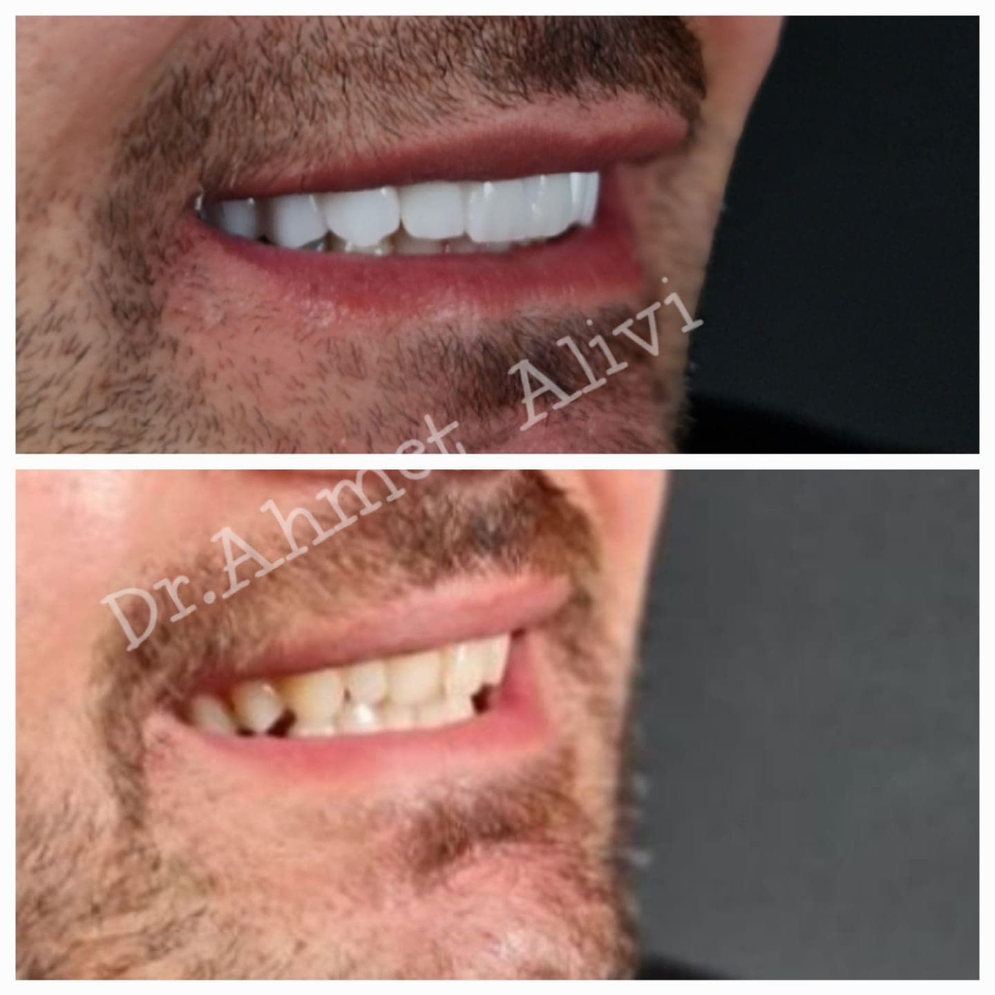 Patient smile transformation before and after #35 — Dr. Alivi Dental Clinic Istanbul