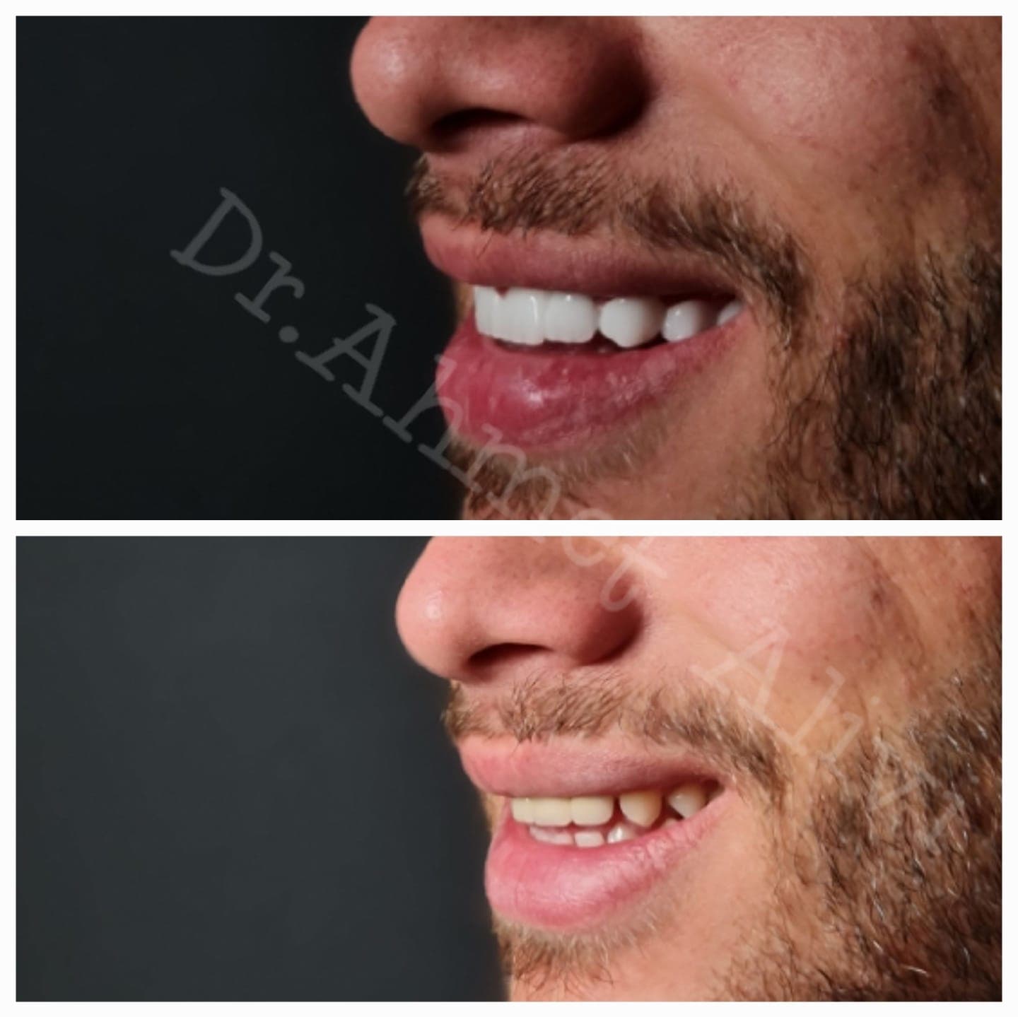 Patient smile transformation before and after #36 — Dr. Alivi Dental Clinic Istanbul