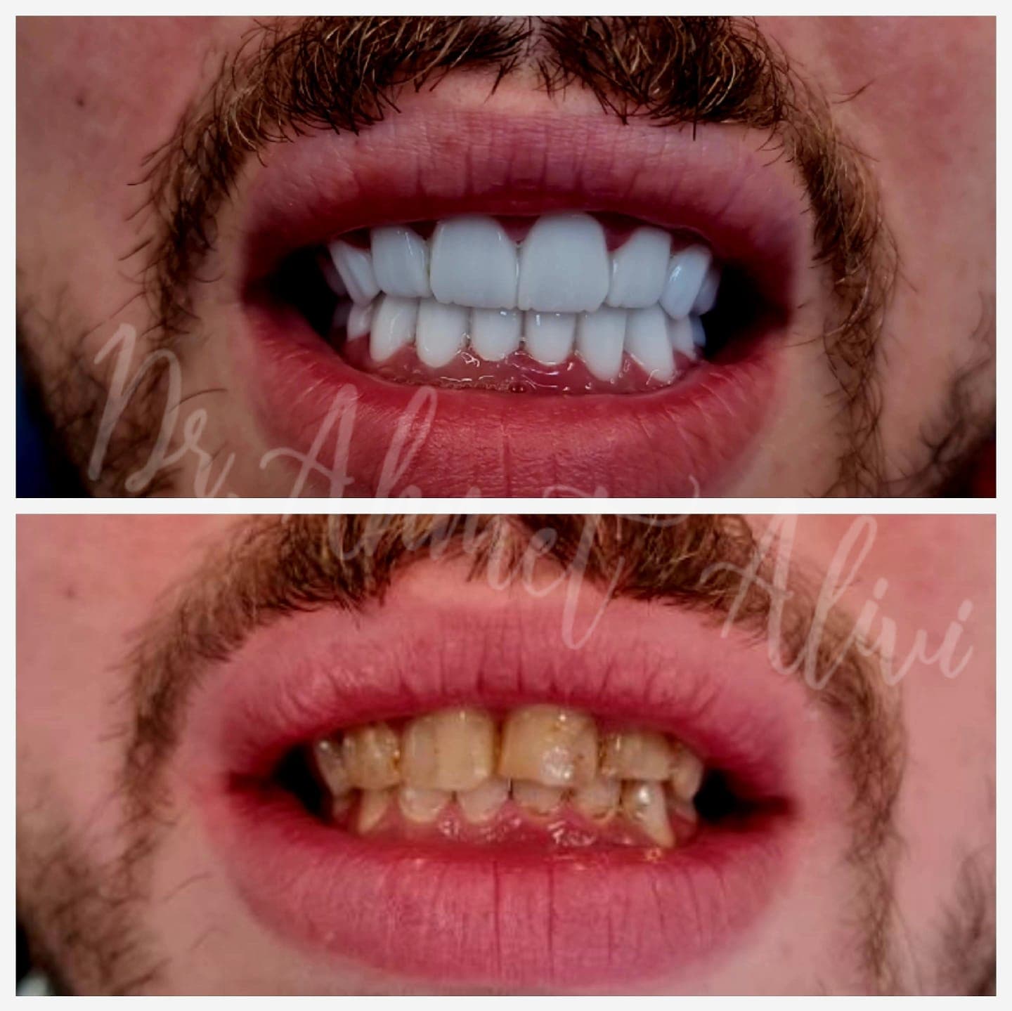 Patient smile transformation before and after #37 — Dr. Alivi Dental Clinic Istanbul