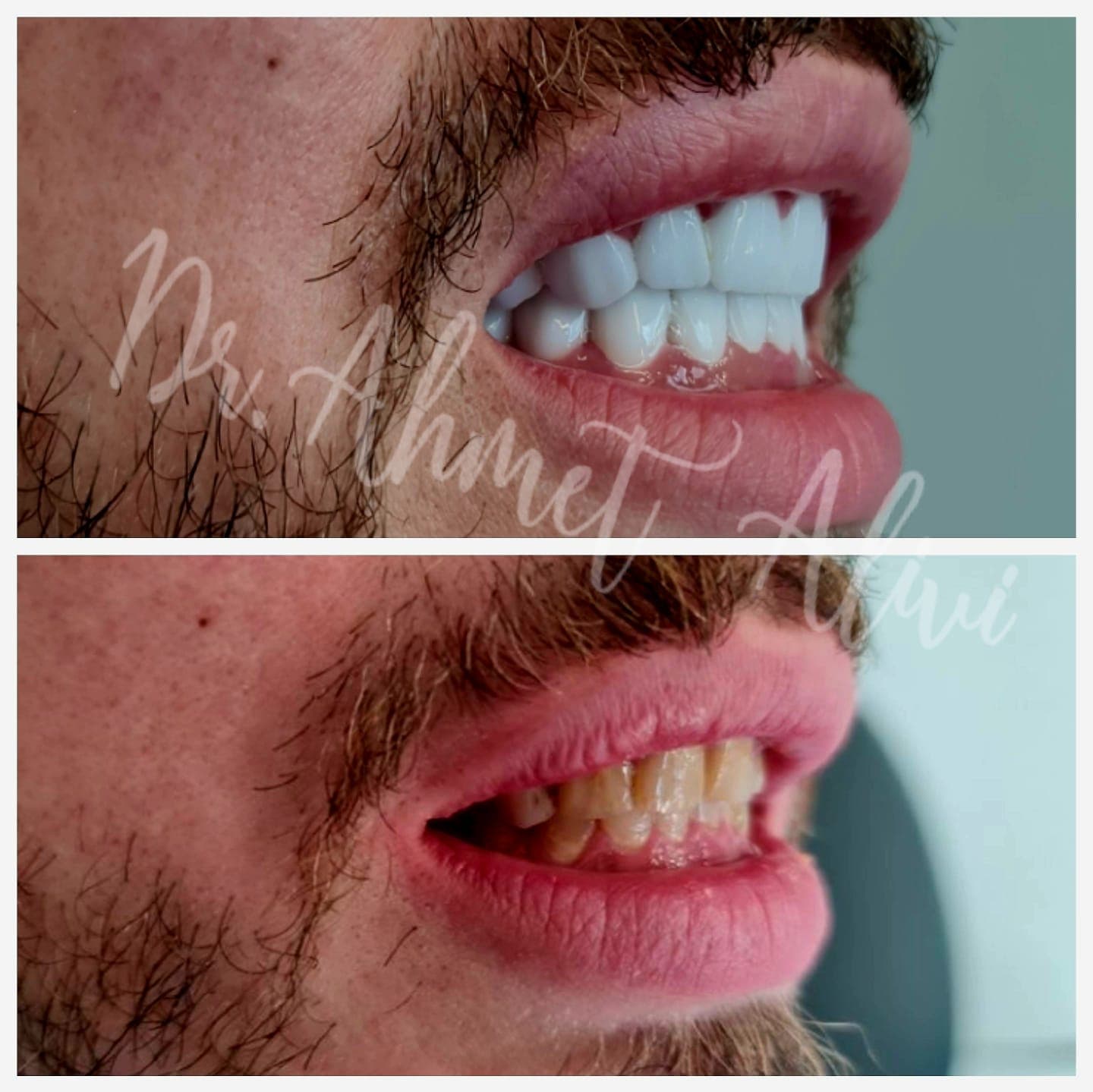Patient smile transformation before and after #39 — Dr. Alivi Dental Clinic Istanbul