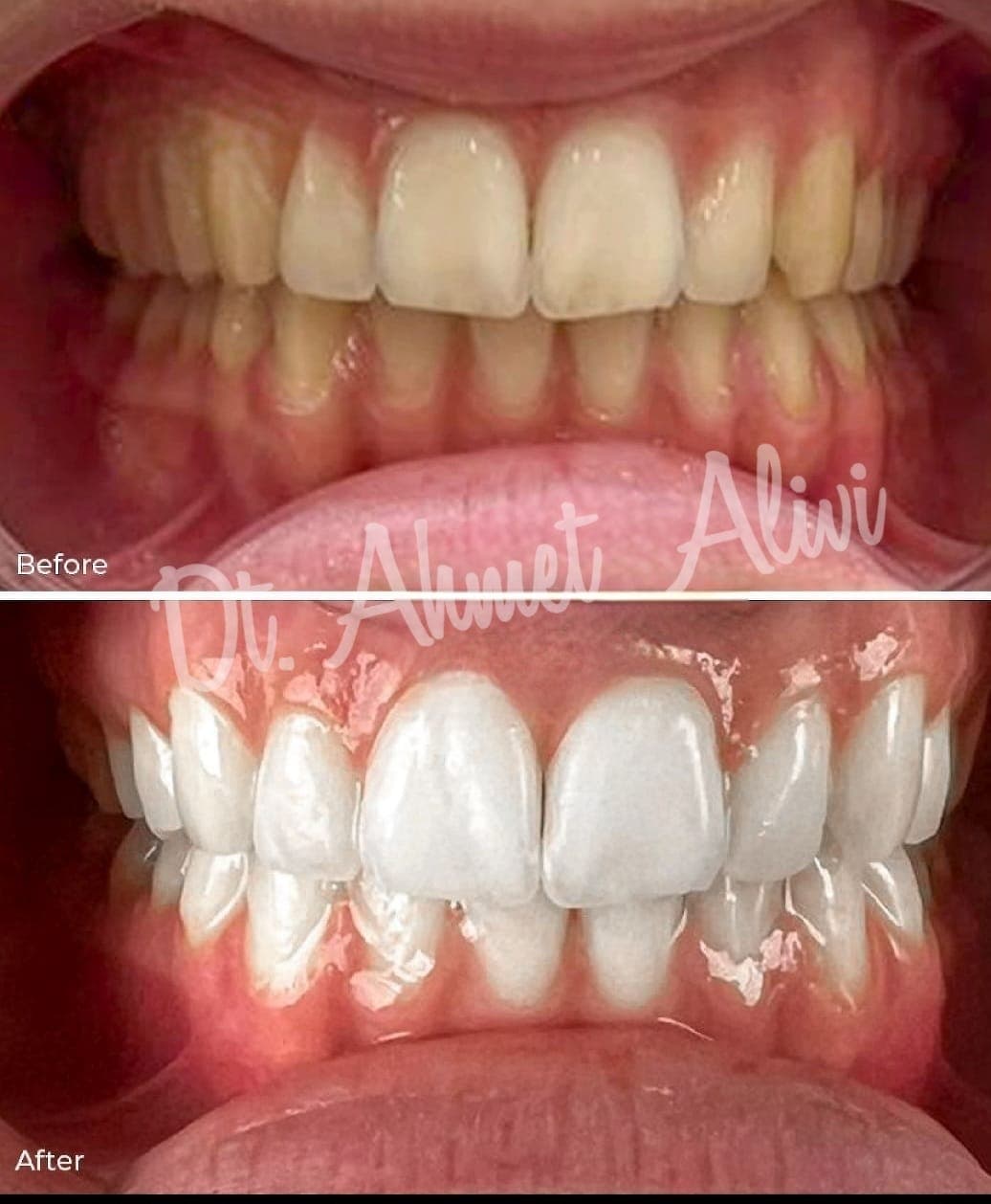 Patient smile transformation before and after #4 — Dr. Alivi Dental Clinic Istanbul