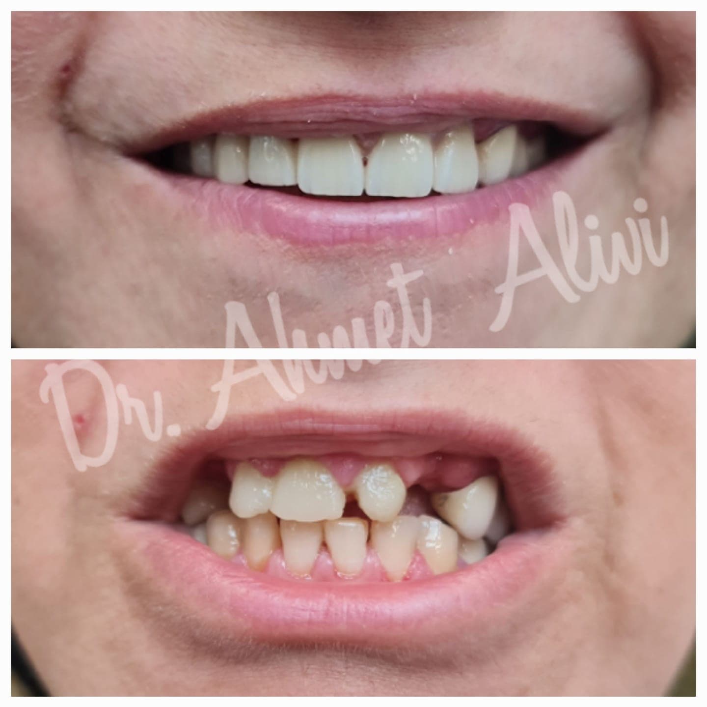 Patient smile transformation before and after #40 — Dr. Alivi Dental Clinic Istanbul