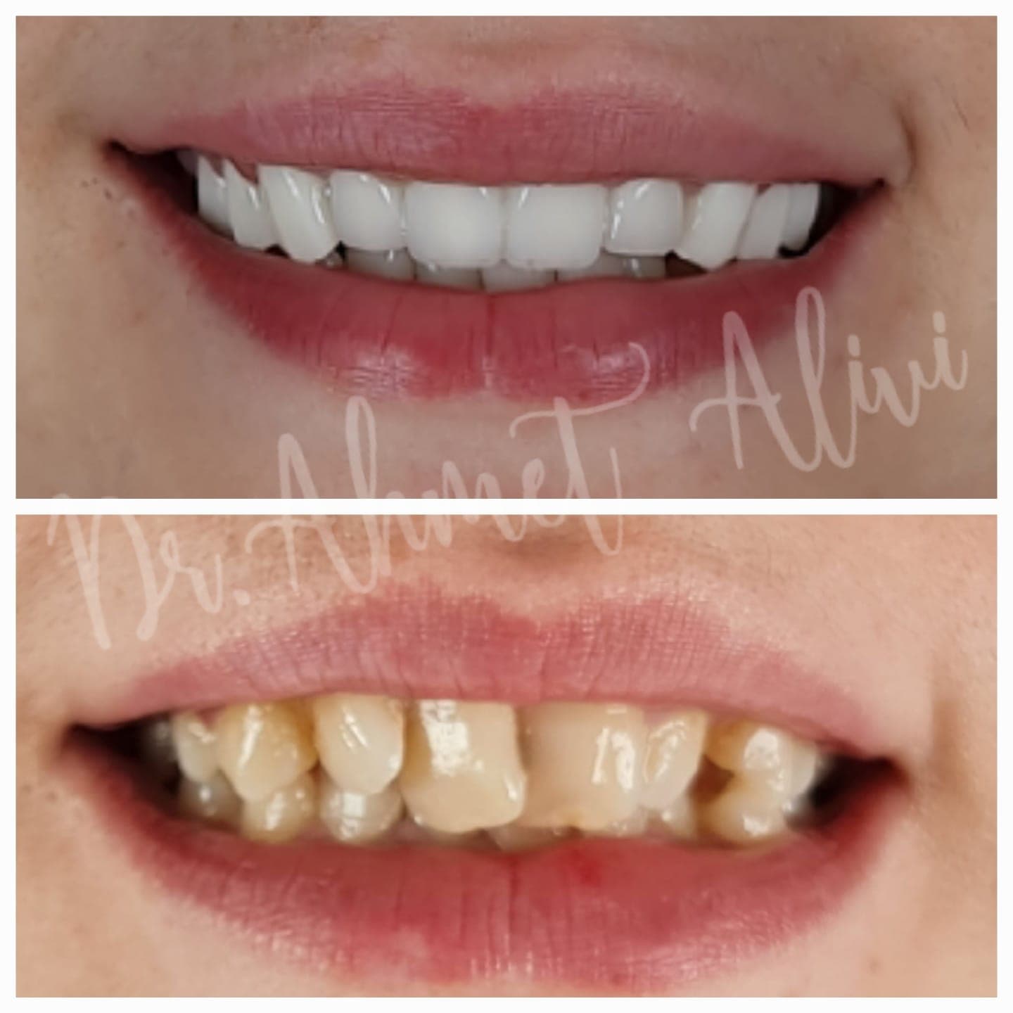 Patient smile transformation before and after #41 — Dr. Alivi Dental Clinic Istanbul
