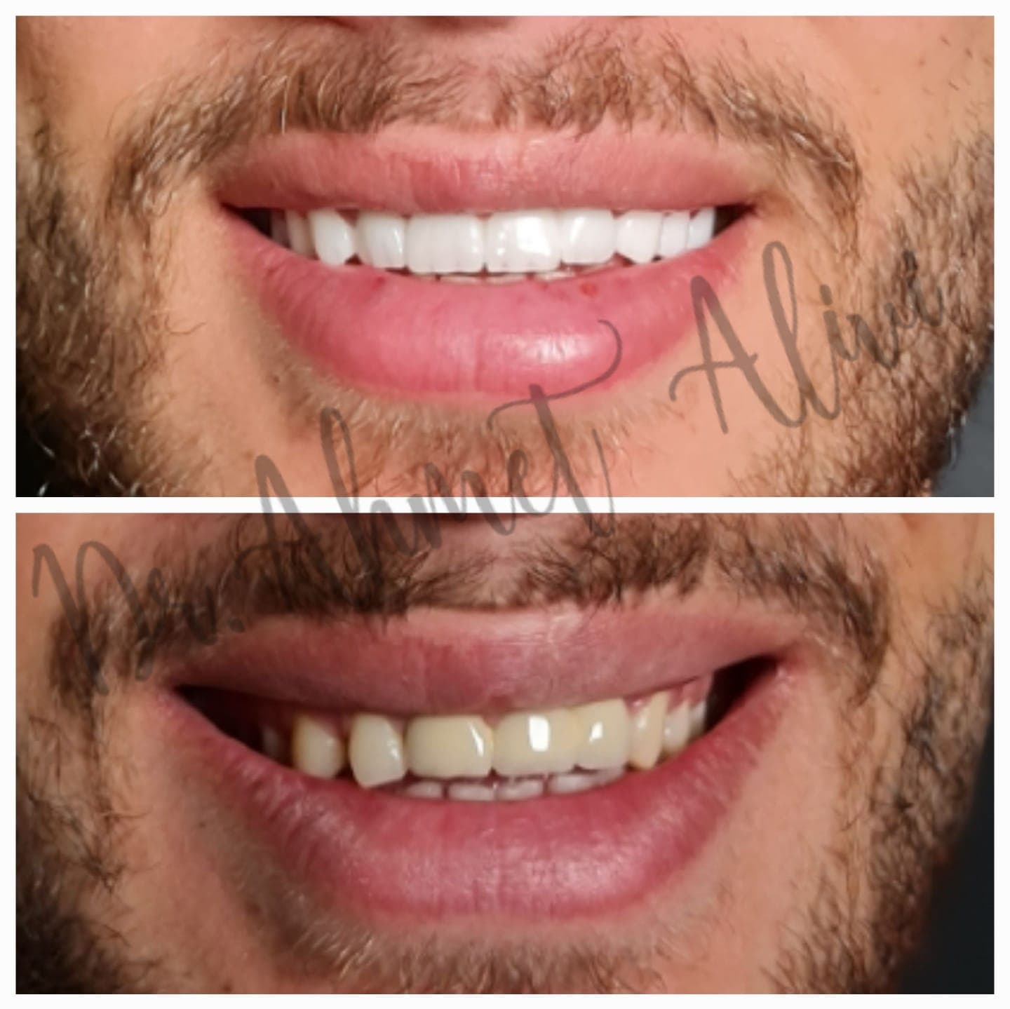 Patient smile transformation before and after #42 — Dr. Alivi Dental Clinic Istanbul
