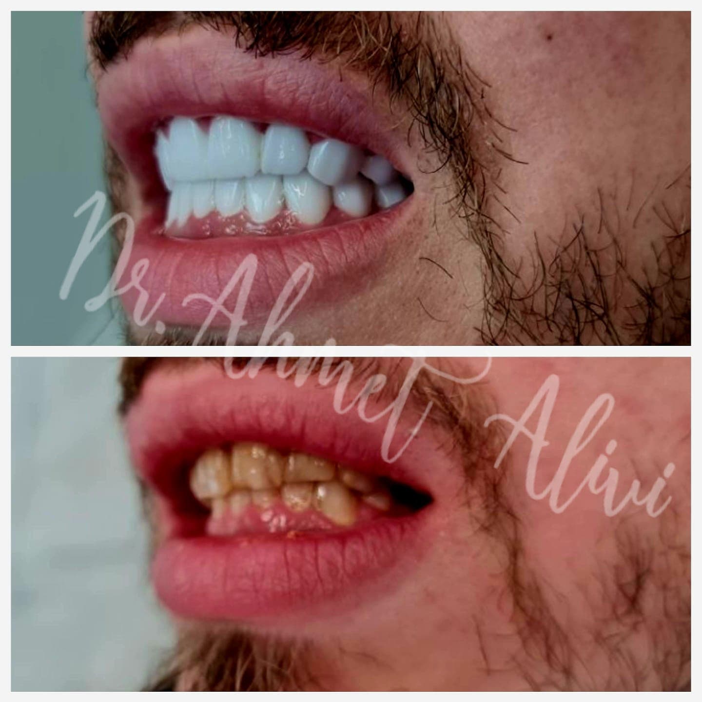 Patient smile transformation before and after #43 — Dr. Alivi Dental Clinic Istanbul