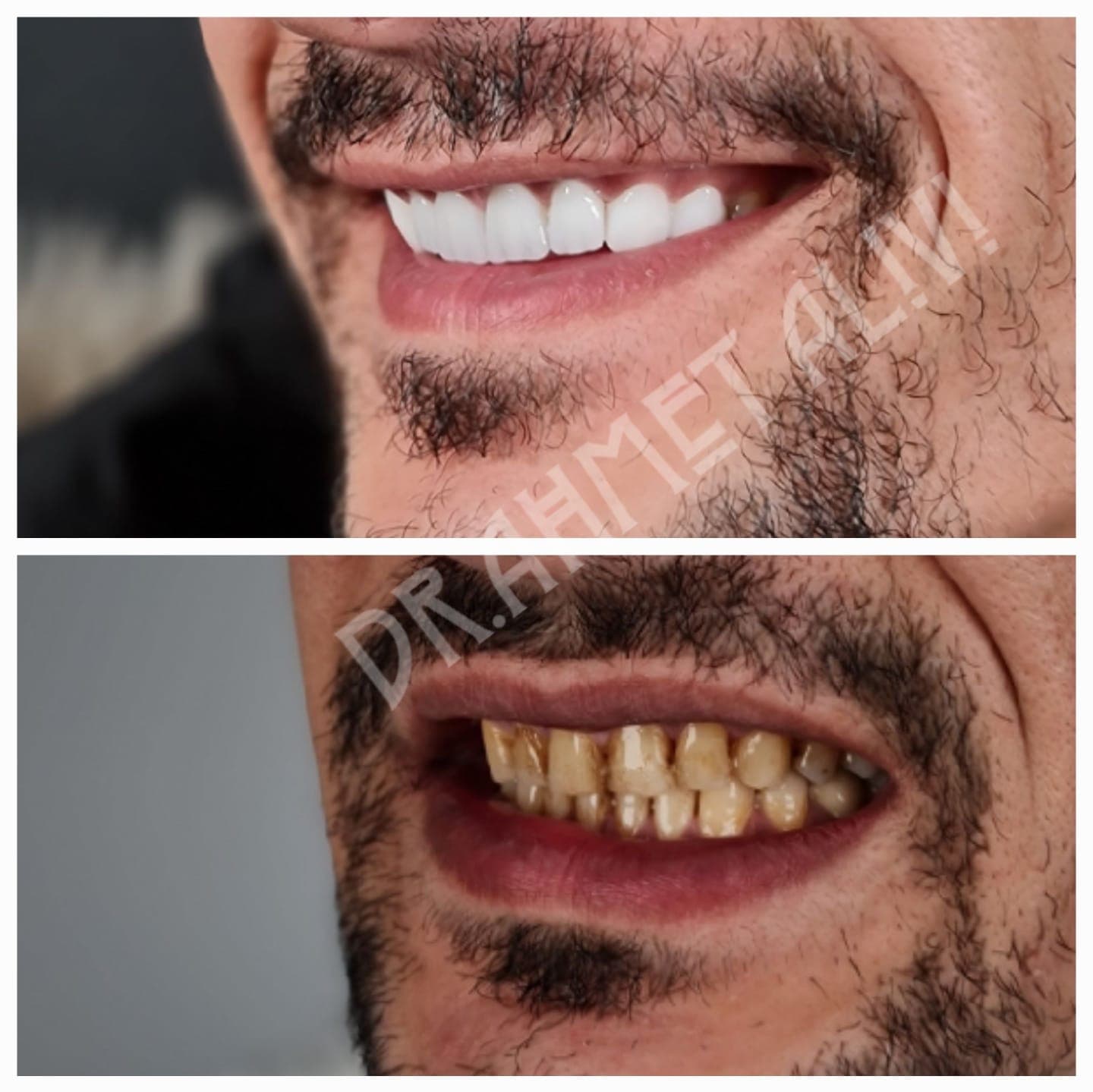 Patient smile transformation before and after #44 — Dr. Alivi Dental Clinic Istanbul