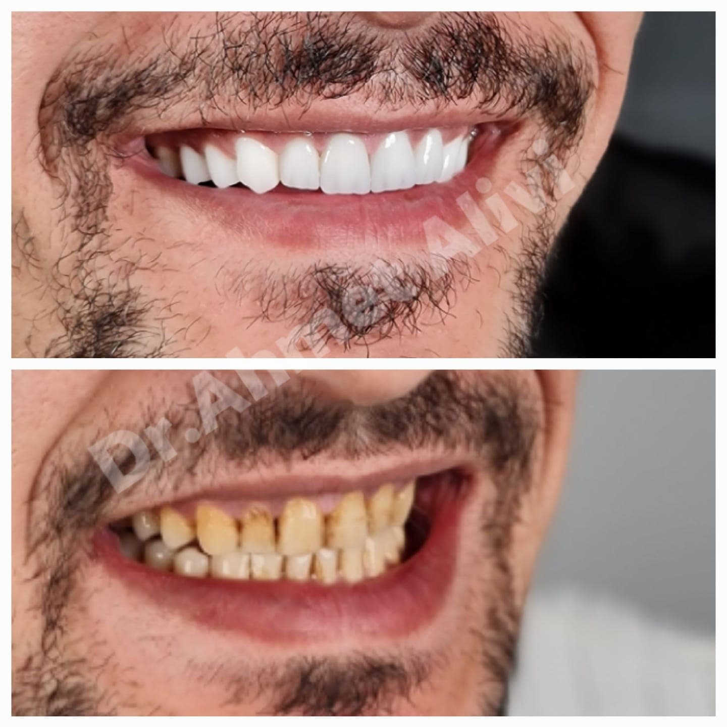 Patient smile transformation before and after #45 — Dr. Alivi Dental Clinic Istanbul