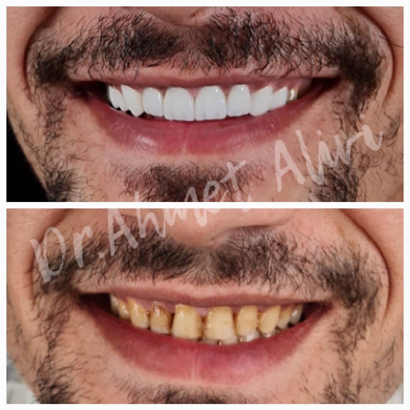 Patient smile transformation before and after #46 — Dr. Alivi Dental Clinic Istanbul
