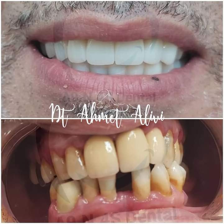 Patient smile transformation before and after #47 — Dr. Alivi Dental Clinic Istanbul