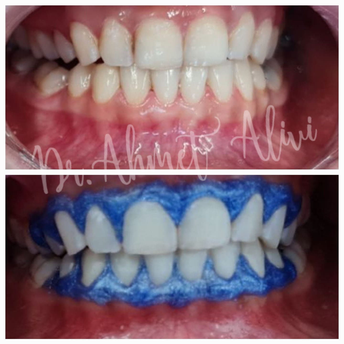 Patient smile transformation before and after #5 — Dr. Alivi Dental Clinic Istanbul