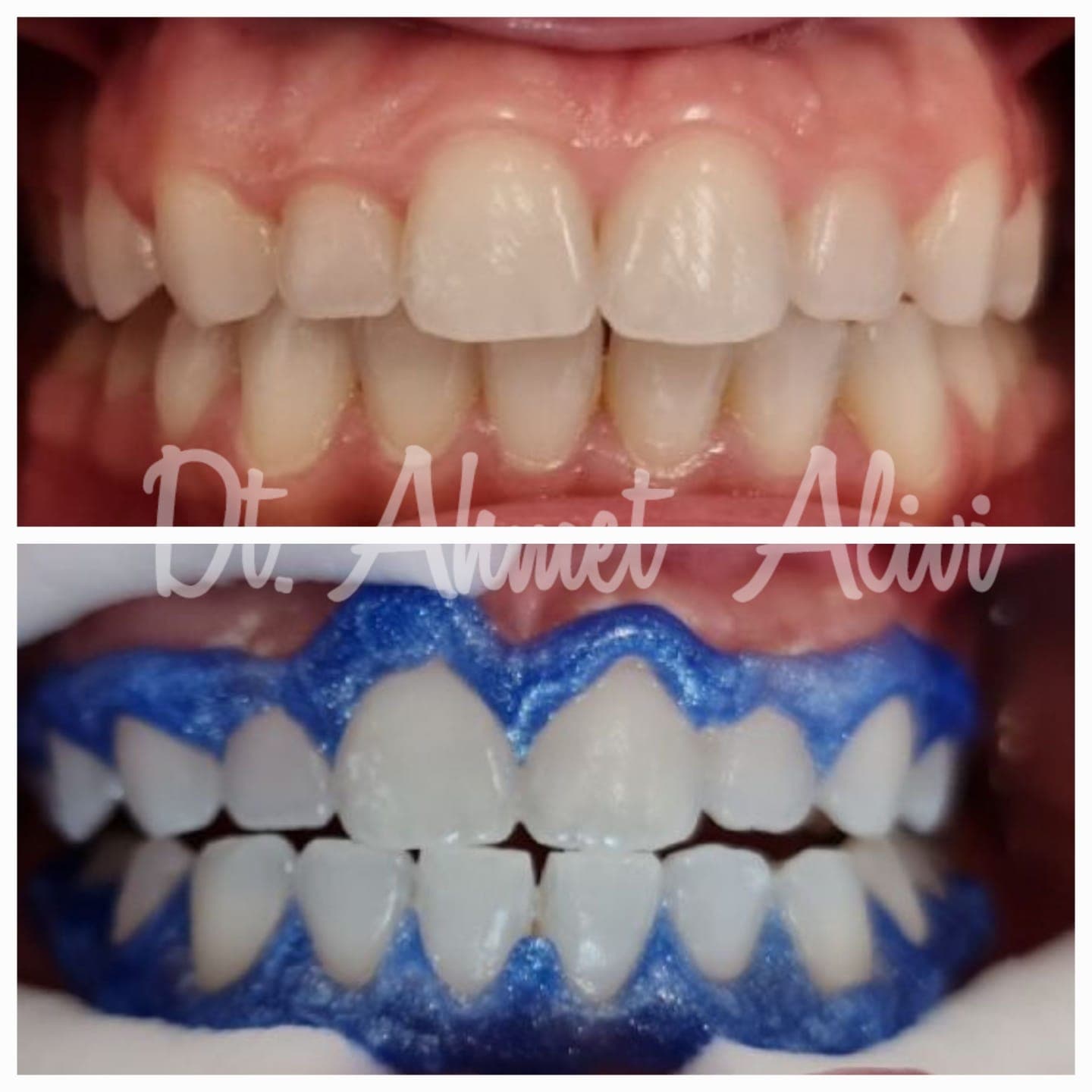 Patient smile transformation before and after #6 — Dr. Alivi Dental Clinic Istanbul