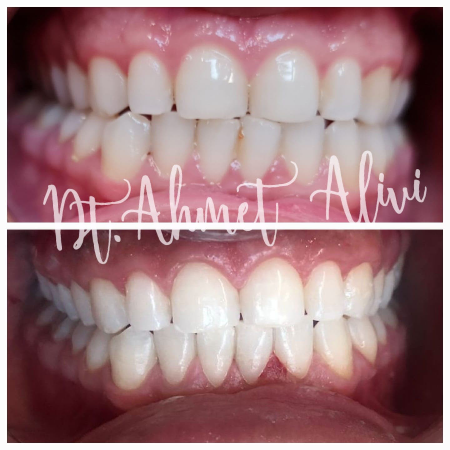 Patient smile transformation before and after #9 — Dr. Alivi Dental Clinic Istanbul